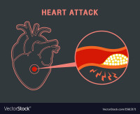 Stop heart attack