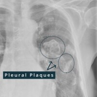 Pleural plaques justice