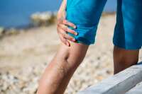 Vein Treatment New Jersey