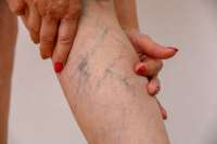Vein Treatment Long Island