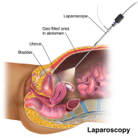 Bix medical  - medical endoscopes and laparoscopes