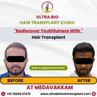 ULTRA BIO HAIR TRANSPLANT CLINIC