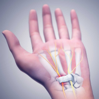 Carpal Tunnel Syndrome Treatment in Surrey