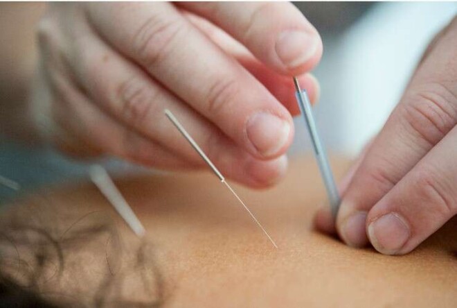 Review Elemental Acupuncture image 359358