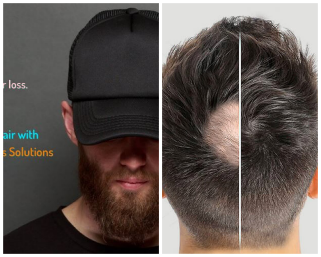 Review Innovative hair loss solutions image 300520